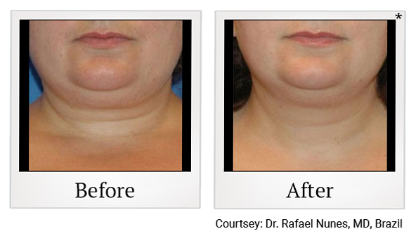 Results 8 of Accent Prime treatment at Harbor Health Center in Capitola