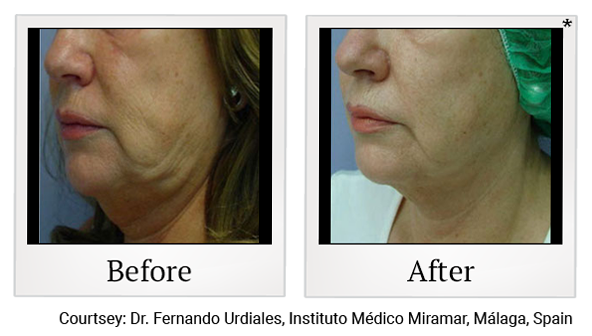 Results 9 of Accent Prime treatment at Harbor Health Center in Capitola