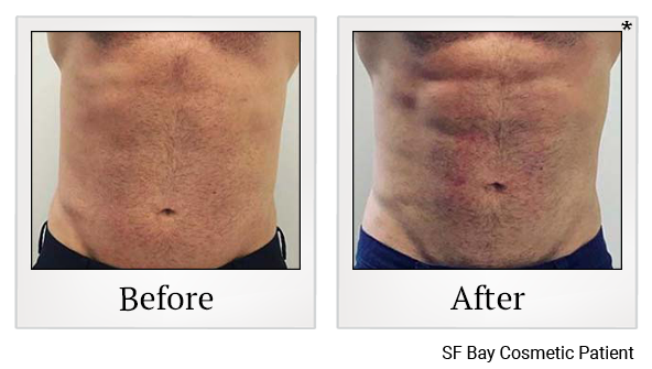 Results 90 of emsculpt treatment at Harbor Health Center in Capitola