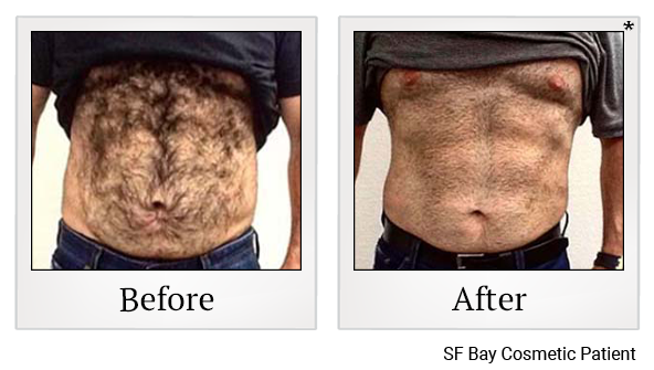 Results 93 of emsculpt treatment at Harbor Health Center in Capitola