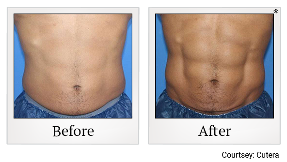 Exilis results 1 at Harbor Health Center in Capitola