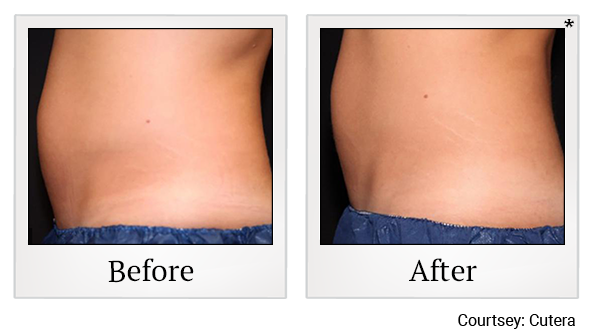 Results 3 of TruSculpt iD treatment at Harbor Health Center in Capitola