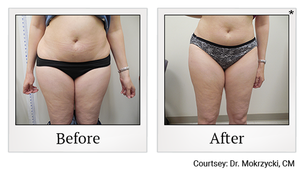 Exilis results 2 at Harbor Health Center in Capitola