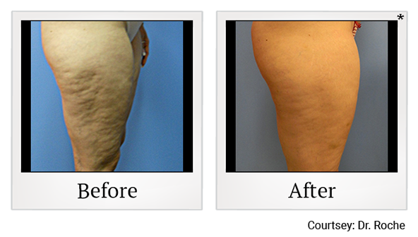 Exilis results 3 at Harbor Health Center in Capitola